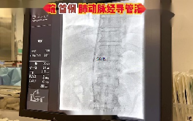 肺动脉血栓清除术